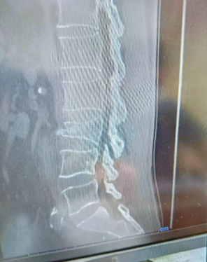 【症例：腰椎3番の圧迫骨折（L3圧迫骨折）】